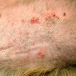 Folliculitis