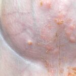 Impetigo