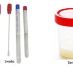 SWAB AND SEMEN SAMPLE FOR LSD